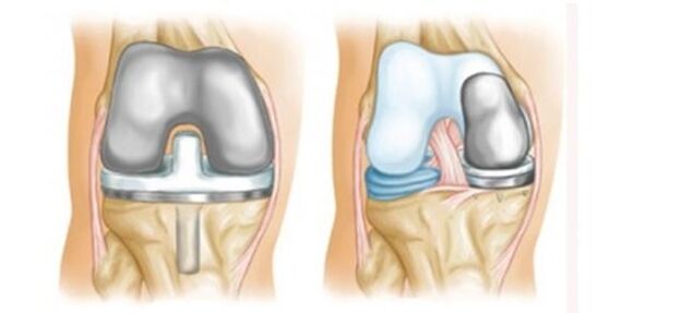 Endoprótesis para la osteoartritis de la articulación de la rodilla. 