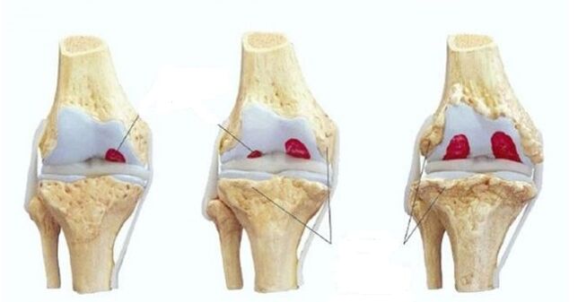 Etapas de la osteoartritis de la articulación de la rodilla. 