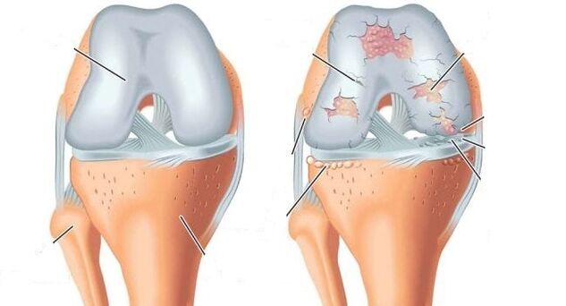 articulación sana y osteoartritis de la articulación de la rodilla