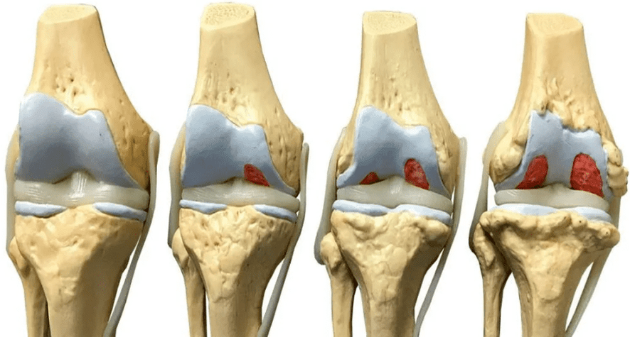 Daño a la articulación de la rodilla en varias etapas del desarrollo de la osteoartritis. 