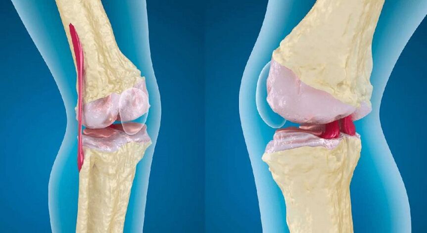 articulación sana y osteoartritis de la articulación de la rodilla