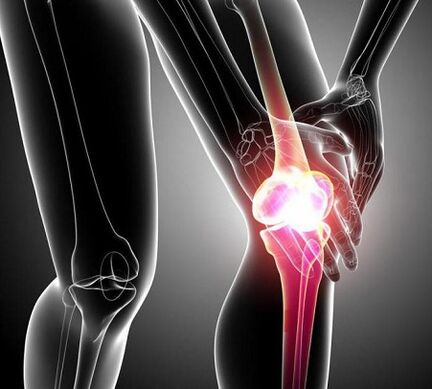 Daño a la articulación de la rodilla por artritis y osteoartritis