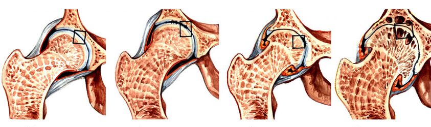 El grado de desarrollo de la osteoartritis de la articulación de la cadera. 