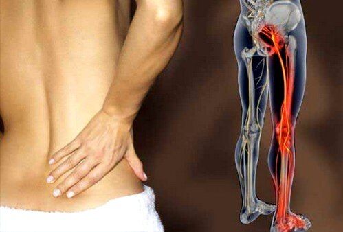 Dolor de espalda por inflamación del nervio ciático