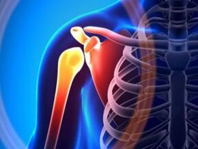 Articulación del hombro inflamada debido a la osteoartritis, una enfermedad crónica del sistema musculoesquelético. 