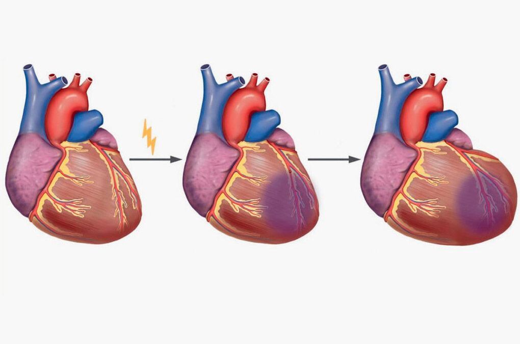 Un infarto provoca dolor en los omóplatos. 
