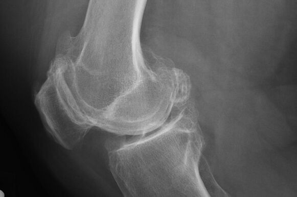 Métodos para diagnosticar la osteoartritis de rodilla