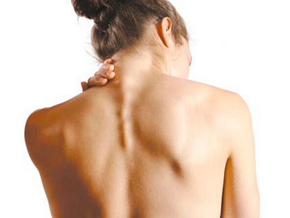 Dolor de cuello debido a osteocondrosis.