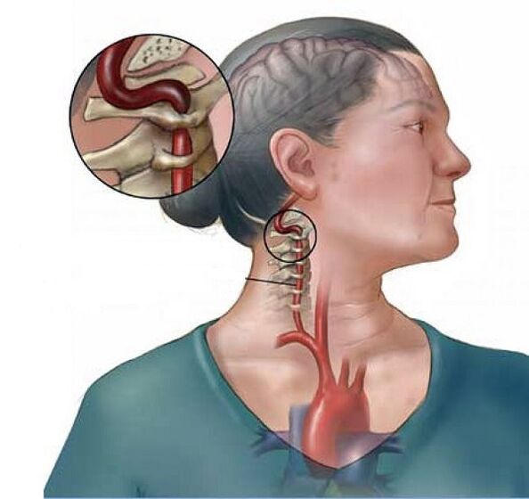 Síndrome de la arteria vertebral con osteocondrosis cervical