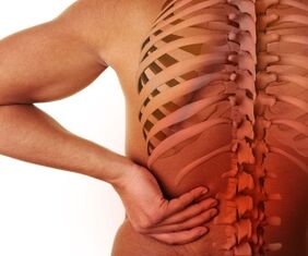 Dolor de espalda con osteocondrosis lumbar.