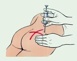 Inyección para el tratamiento de la osteocondrosis.